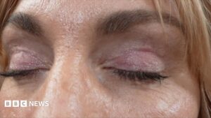 'My eyelids became infected – I was scared to sleep'