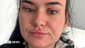 Open wounds and eyes that can't close – women warn about cheap bleph eyelid surgery