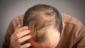 Ozempic and Wegovy may raise hair loss risk in some men