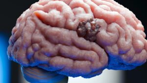 Scientists find a weak spot in one of the deadliest brain cancers