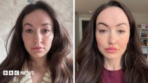 Is 'ferritin face' a real thing – and can you really spot low iron from looks?